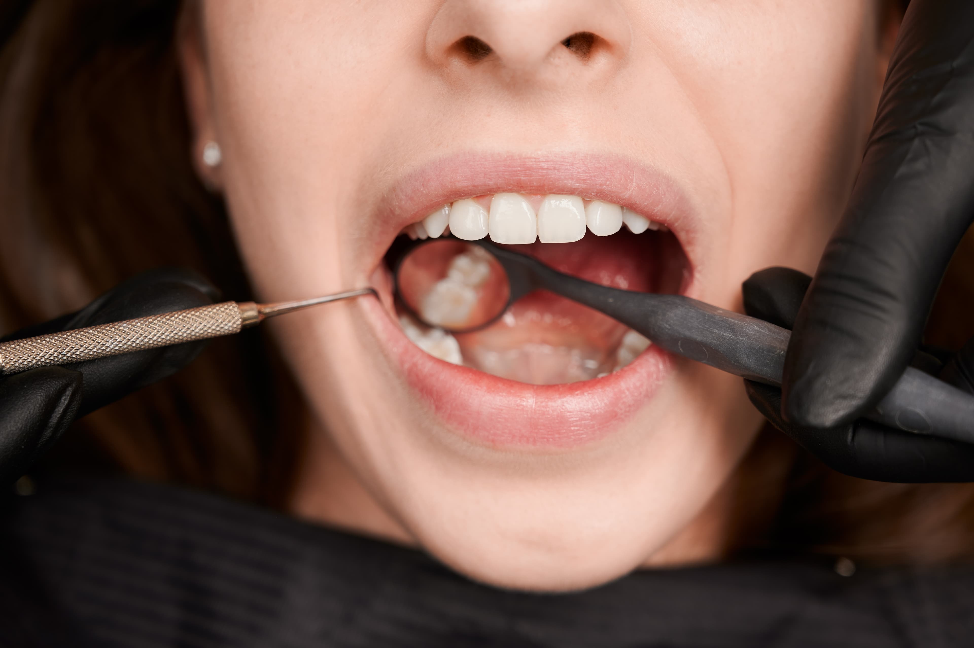 Ce Que Vous Devez Savoir Sur Les Dents De Sagesse